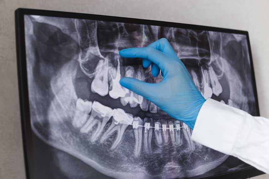 Root canals