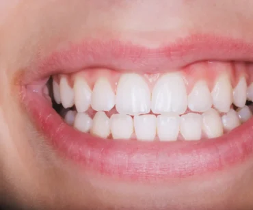 How to Prevent Receding Gums