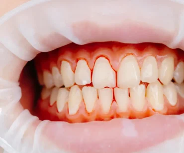 Signs of gingivitis