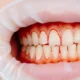Signs of gingivitis
