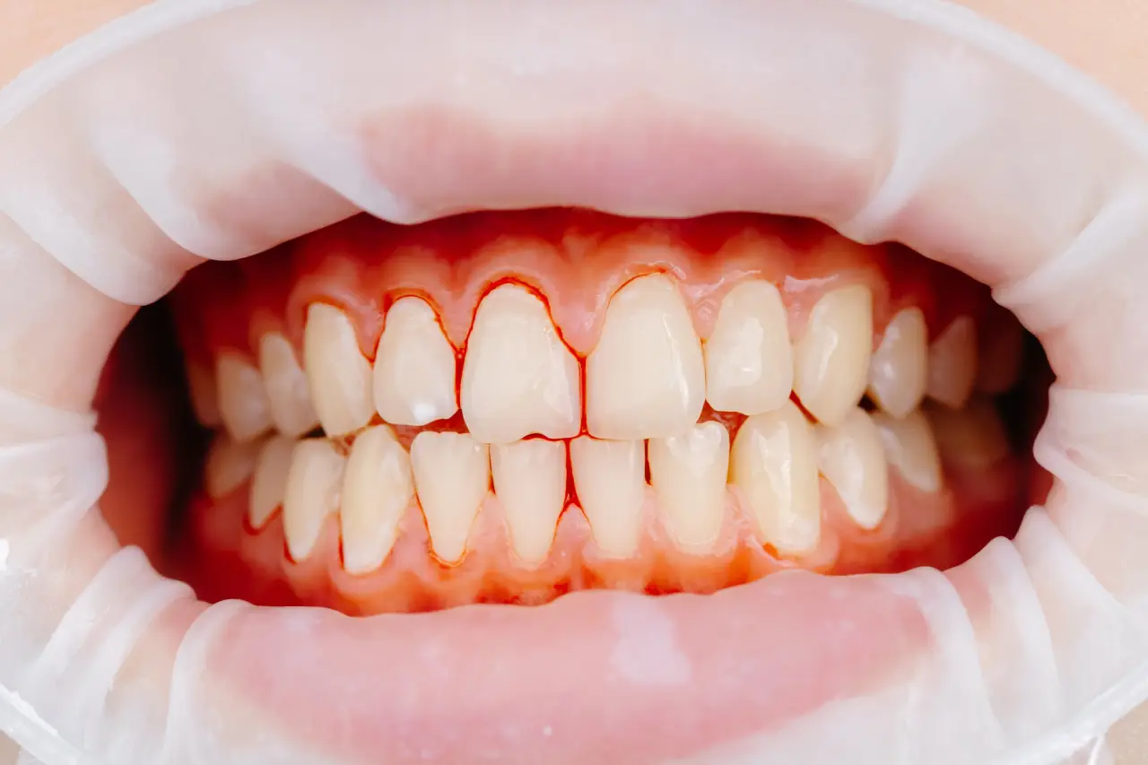 Signs of gingivitis