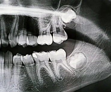 x ray image of jaw with teeth visible