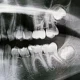 x ray image of jaw with teeth visible