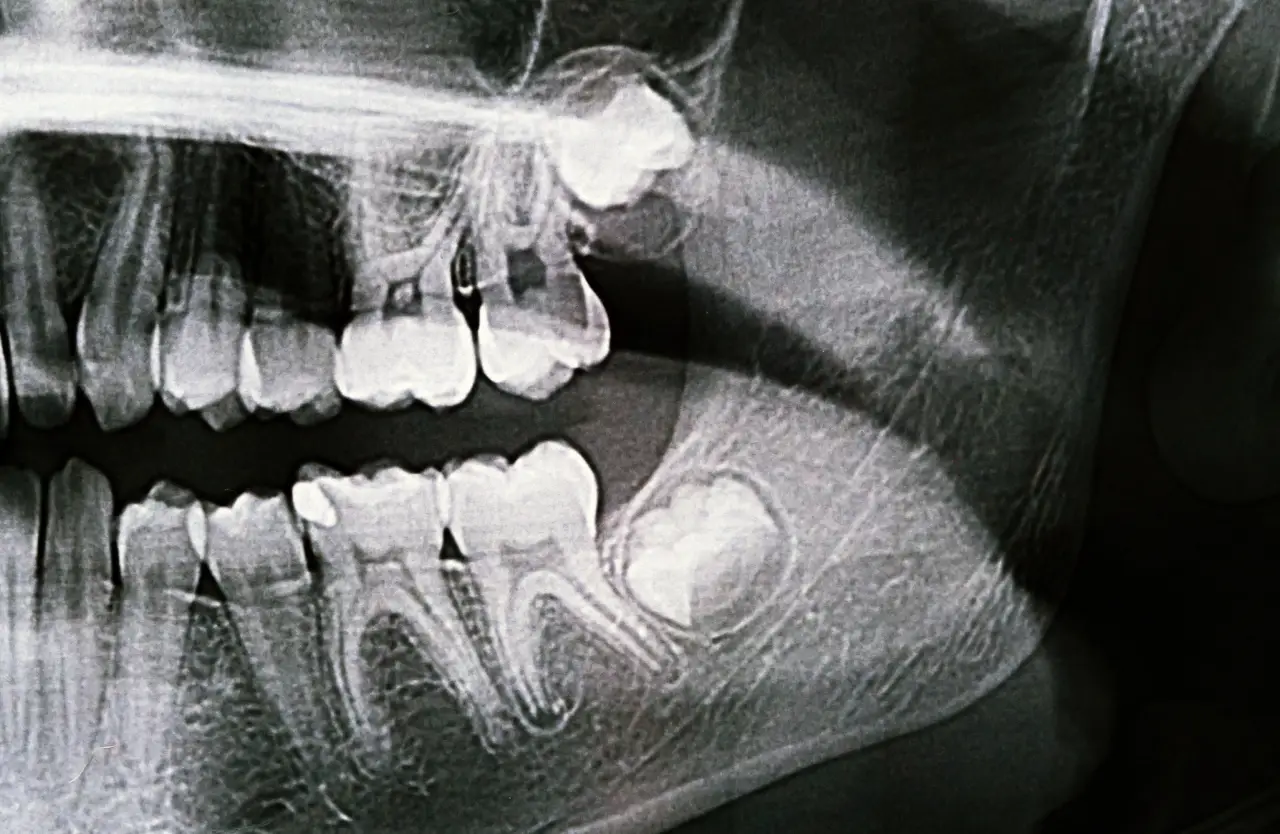 x ray image of jaw with teeth visible